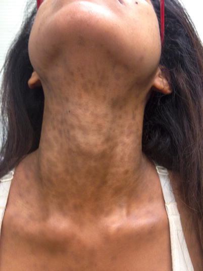 EDP manifesting in the neck of a patient