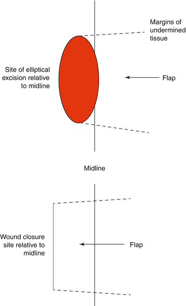 Figure X3. Bascom procedure