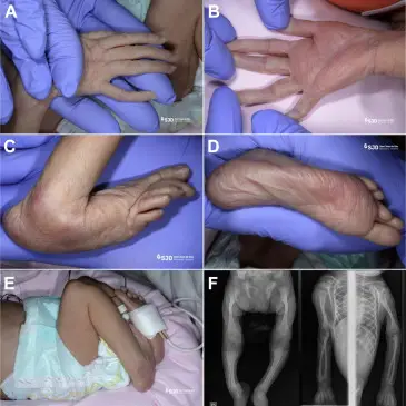 clinical manifestations of Marfan syndrome