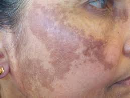 lesions in skin affected by post-inflammatory hypopigmentation