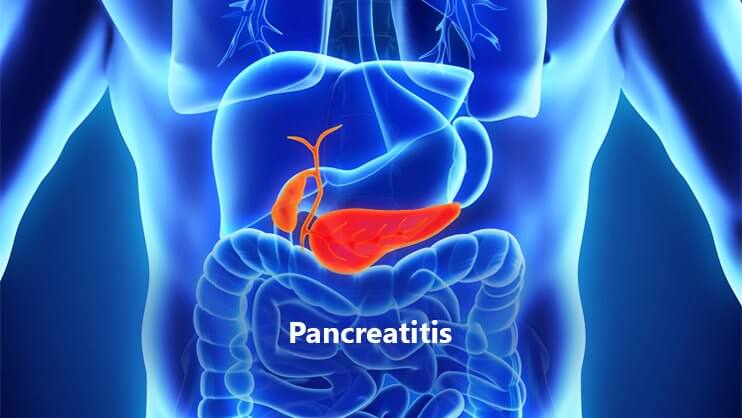 pancreatitis image