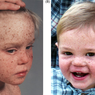 Figure X-1 | Pronounced mottled pigmentation of the face of a child.