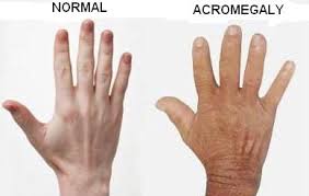 enlarged hands in patient with acromegaly