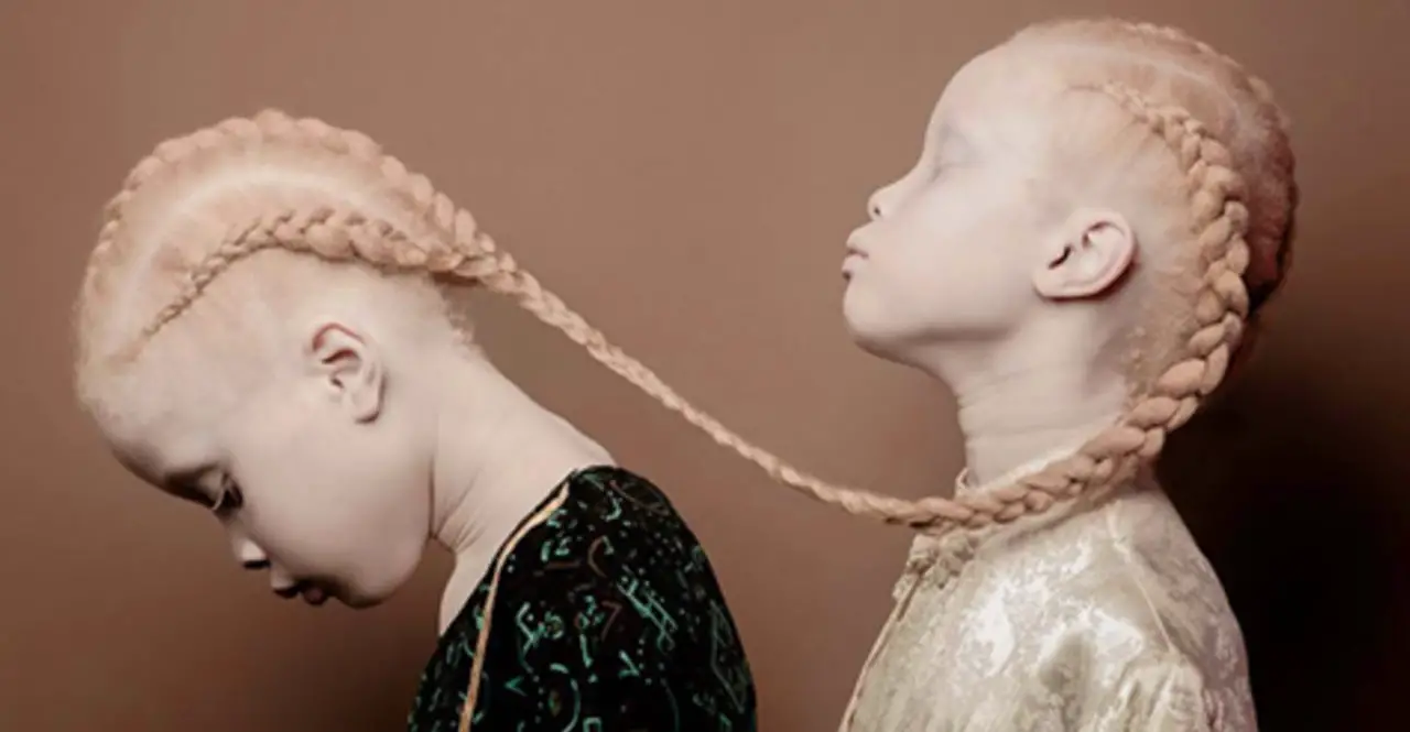Two girls manifesting albinism