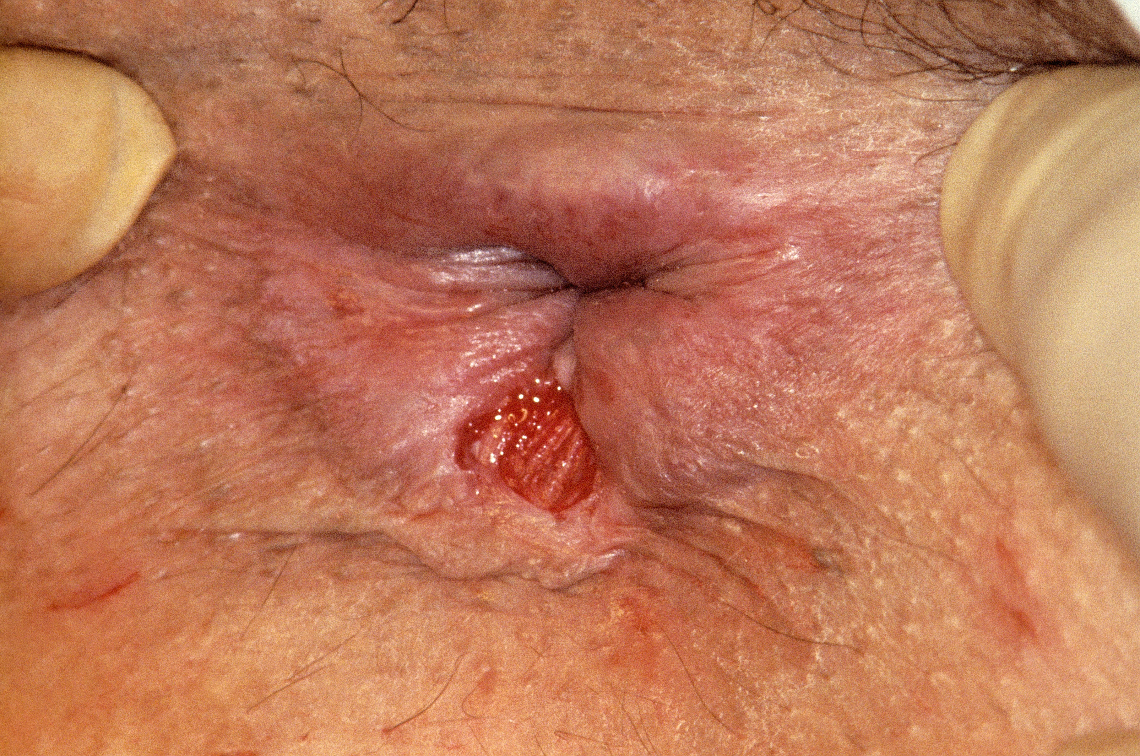 anal fissure image