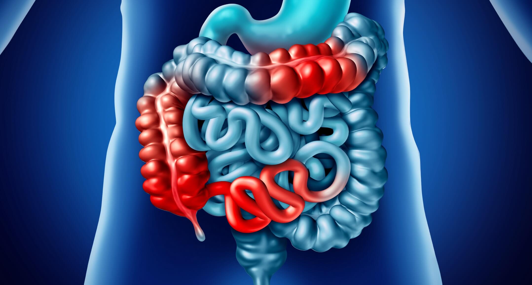 crohn's disease image