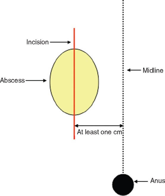 Incision placement for pilonidal abscess