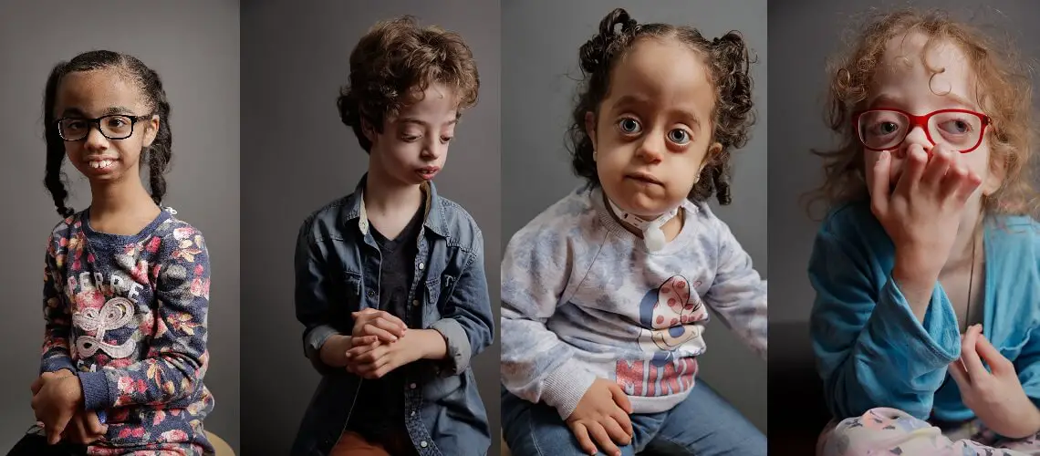 an infant with Sotos syndrome