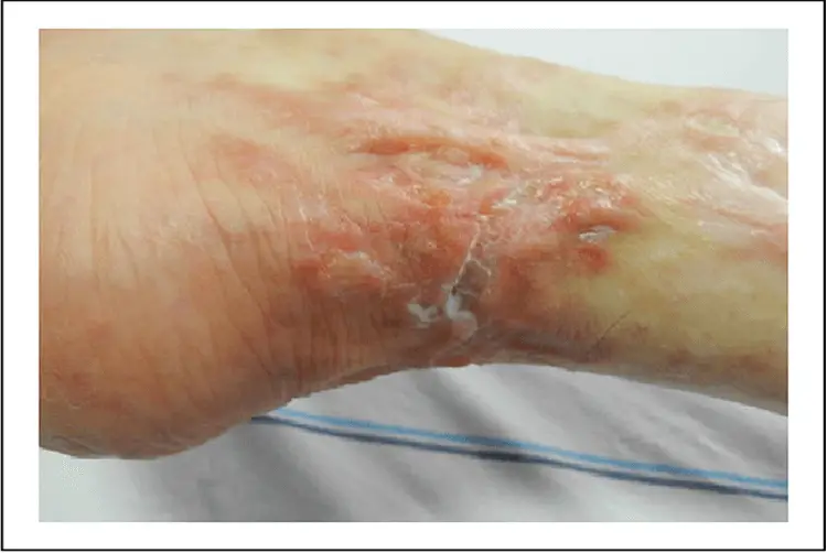 A Case of Prolidase Deficiency Accompanying Leg Ulcers