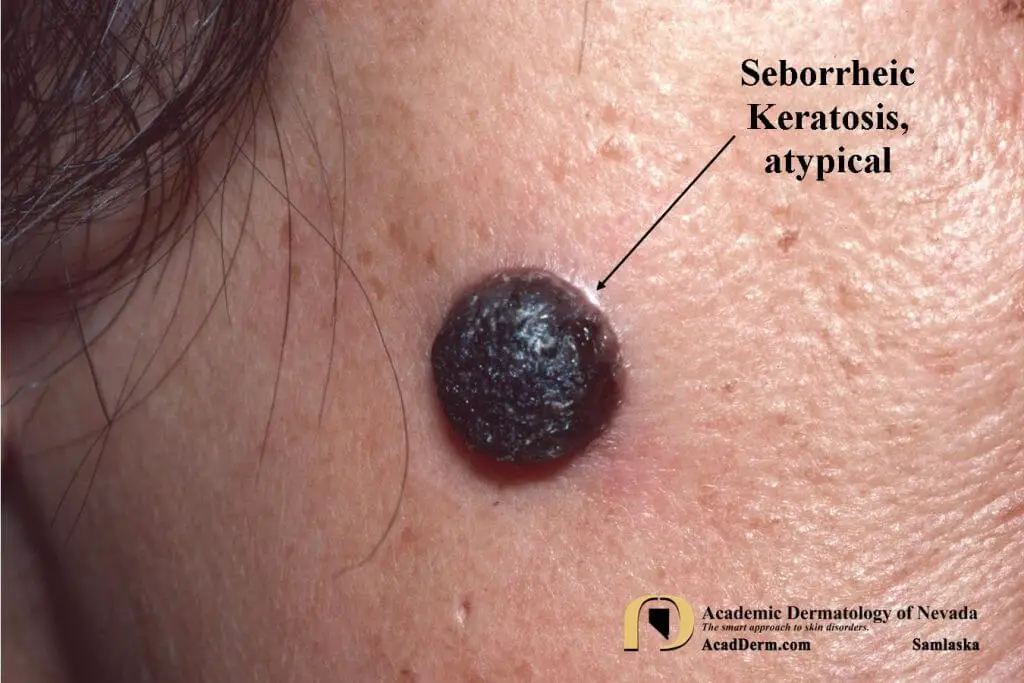 Clinical symptoms of seborrheic keratosis